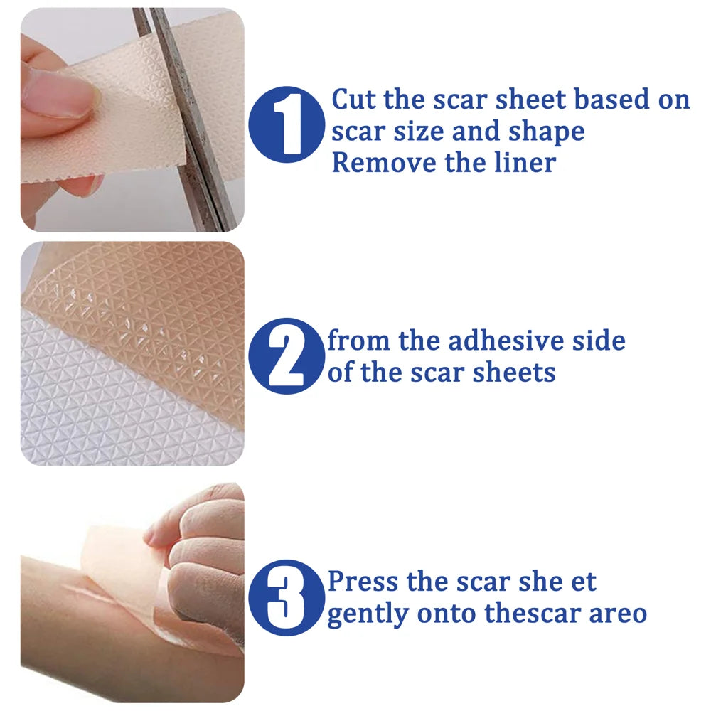 SOUTH MOON 4Pcs Silicone Scar Sheets Self Adhesive Burn Wound Healing Skin Smoothing Patches - 6