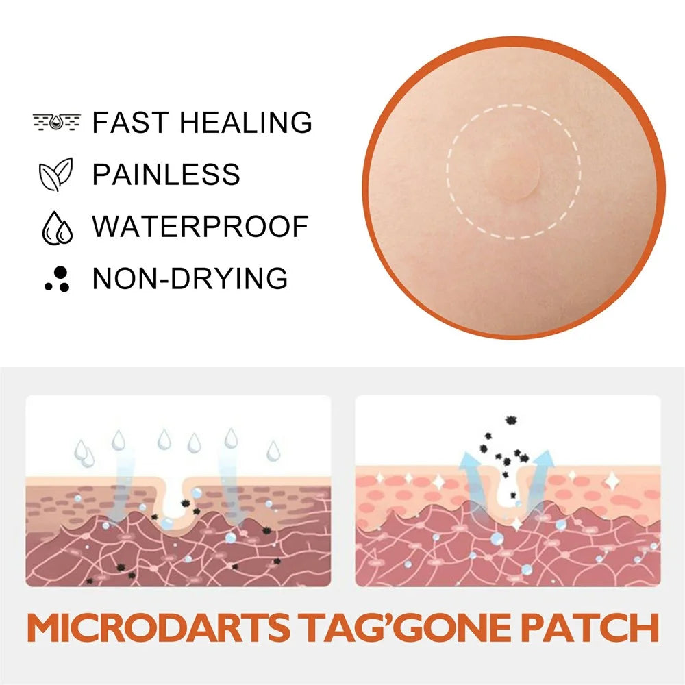 OUHOE 144Pcs Acne Patches Non Irritating Skin Blemish Treatment Pimple Sticker, OUA03-A039-144-WH1 - 5