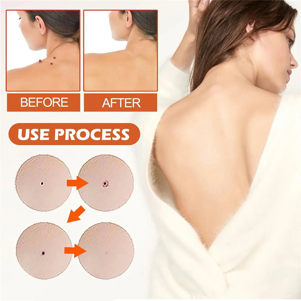 OUHOE 144Pcs Acne Patches Non Irritating Skin Blemish Treatment Pimple Sticker, OUA03-A039-144-WH1 - 7