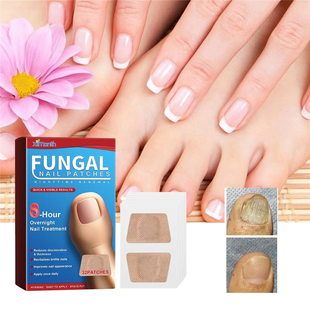 XIMONTH XIB05-A006-32-BU1 32Pcs Fungal Nail Patches Ingrown Toenail Overnight Repair Treatment - 2
