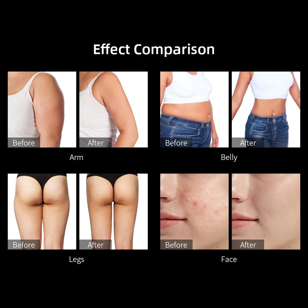 40K Cavitation Ultrasonic Weight Loss Beauty Machine RF Radio Frequency Skin Lifting Device, CE Certified (ST) - EU Plug - 6